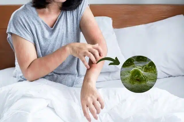 Persona rascándose el brazo, sentada en una cama blanca. Inserción ampliada de ácaros verdes visibles.